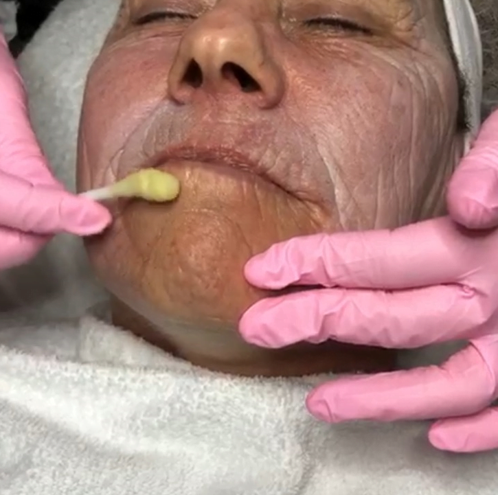 peeling