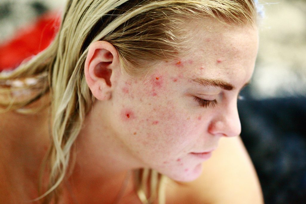 acne / sebacia www.skin-prof.nl Pixabay