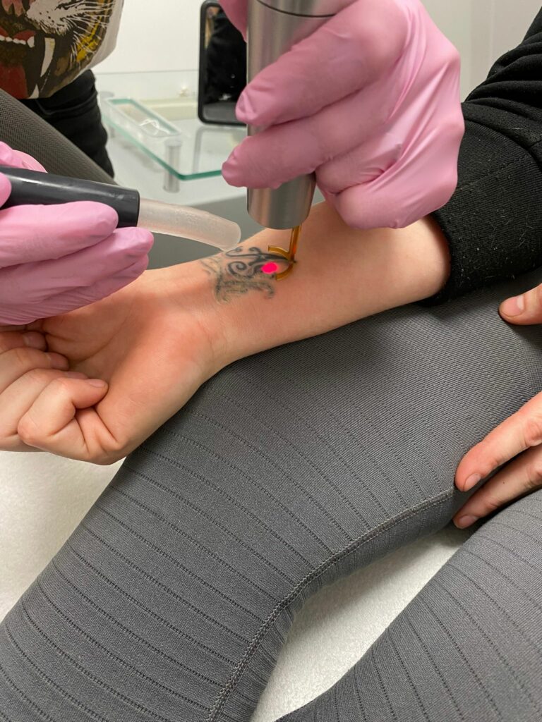 tatoeage verwijderen
